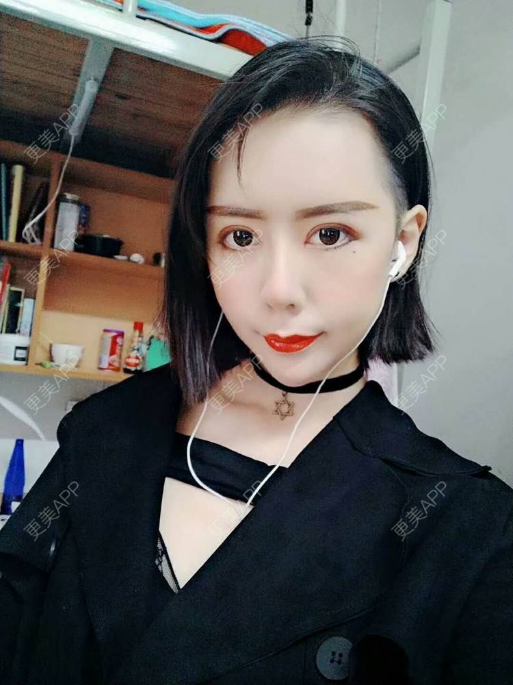 更美 - 哑琳的自体脂肪丰苹果肌经验 | 自体脂肪丰苹果肌 | 自体脂肪垫下巴 | 自体脂肪丰额头 | 自体脂肪填充法令纹 | 深圳 | 自体脂肪全面部填充