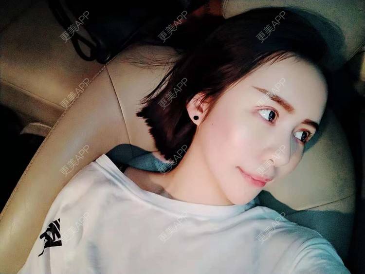 更美 - 哑琳的自体脂肪丰苹果肌经验 | 自体脂肪丰苹果肌 | 自体脂肪垫下巴 | 自体脂肪丰额头 | 自体脂肪填充法令纹 | 深圳 | 自体脂肪全面部填充