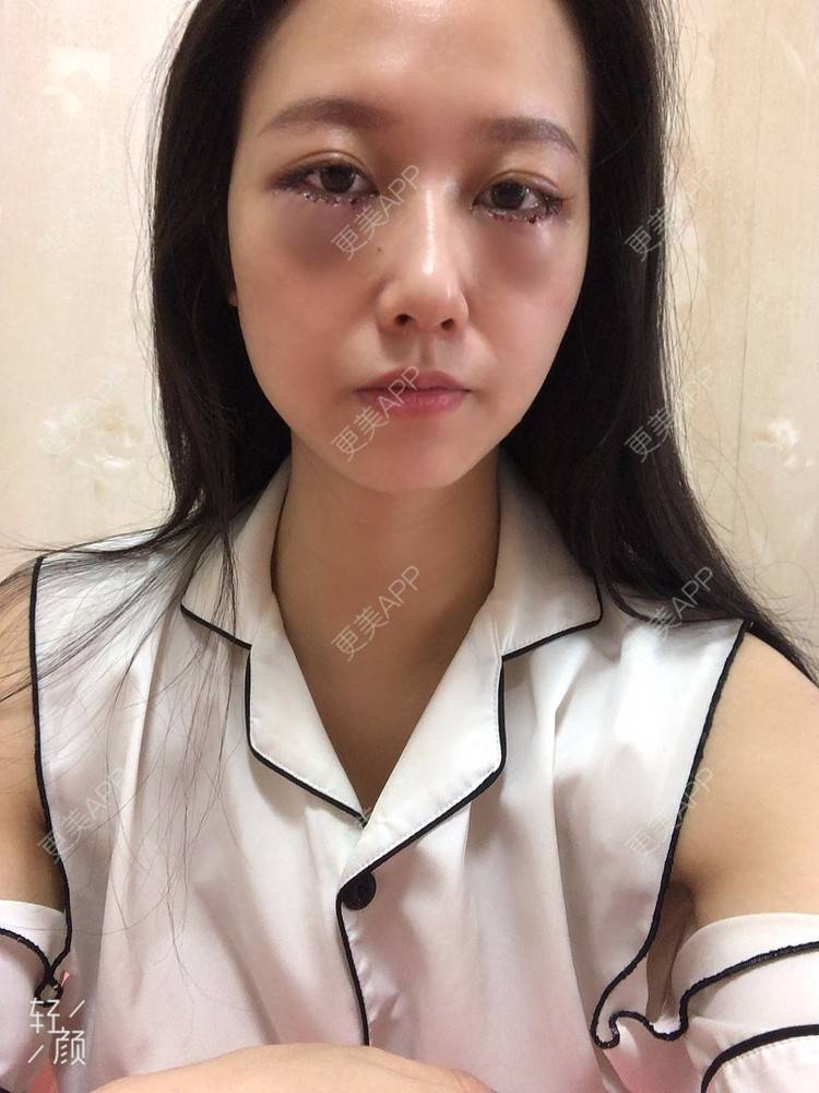 祈祷鳄鱼的外切去眼袋日记