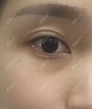 更美 - 更美用户8mkpT4r4XA的胶原蛋白丰泪沟经验 | 胶原蛋白丰泪沟
