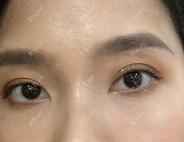 更美 - 更美用户8mkpT4r4XA的胶原蛋白丰泪沟经验 | 胶原蛋白丰泪沟