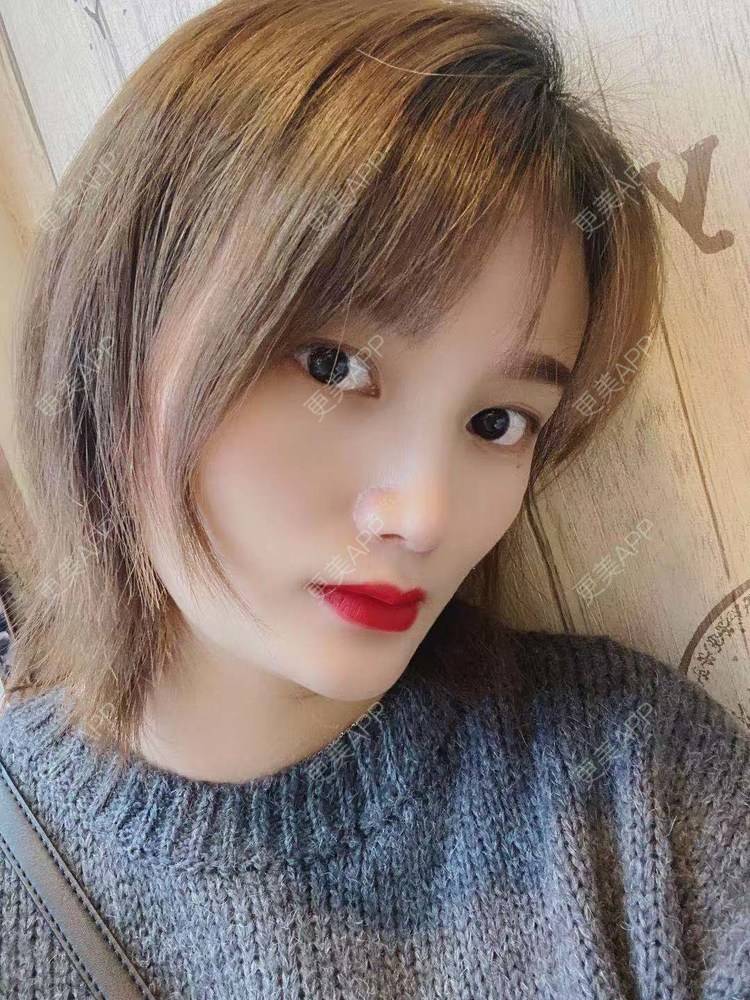 更美 - 林玲儿响叮当的隆鼻经验 | 广州 | 隆鼻