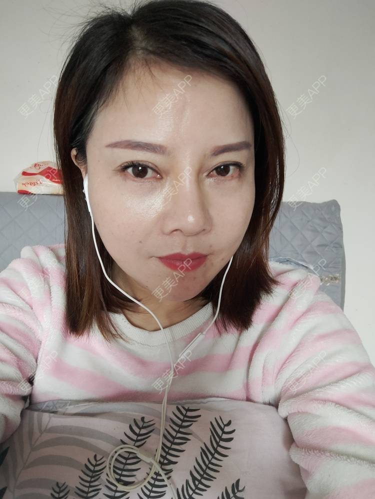 更美 - 更美用户xZI1wSP5Ch的隆鼻经验 | 隆鼻 | 肋软骨隆鼻 | 上海 | 自体肋软骨垫鼻基底
