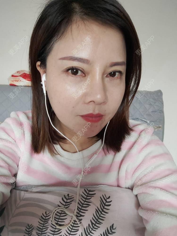 更美 - 更美用户xZI1wSP5Ch的隆鼻经验 | 隆鼻 | 肋软骨隆鼻 | 上海 | 自体肋软骨垫鼻基底