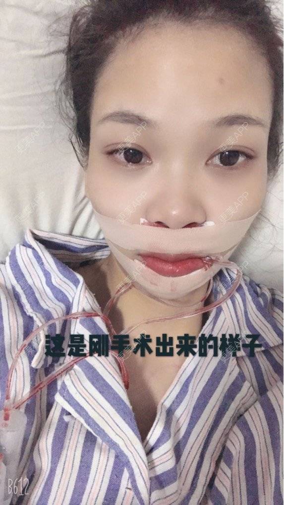 更美 - 萍萍姐呀的凸嘴矫正经验 | 广州 | 凸嘴矫正