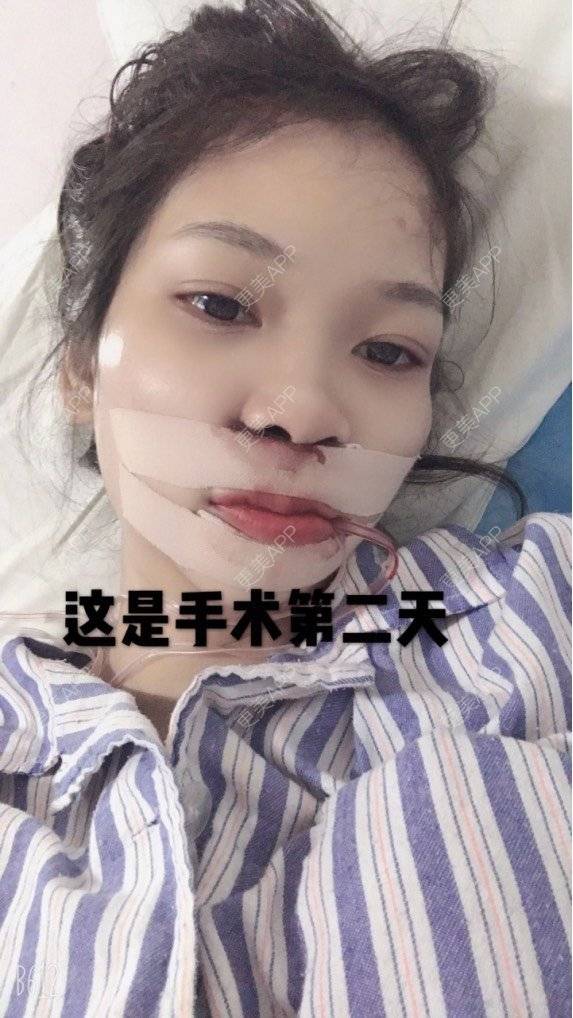 更美 - 萍萍姐呀的凸嘴矫正经验 | 广州 | 凸嘴矫正