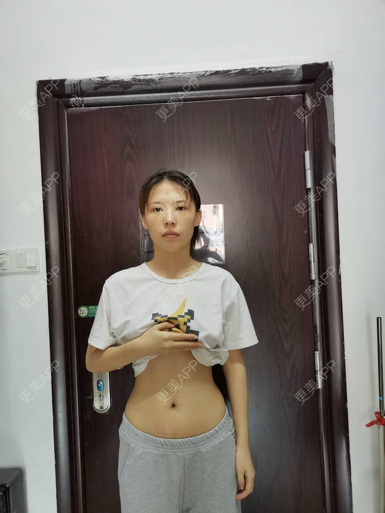 更美 - 更美用户x44KhGeKO3的剖腹产手术经验 | 激光淡疤 | 剖腹产手术 | 综合淡疤 | 皮肤美容 | 成都