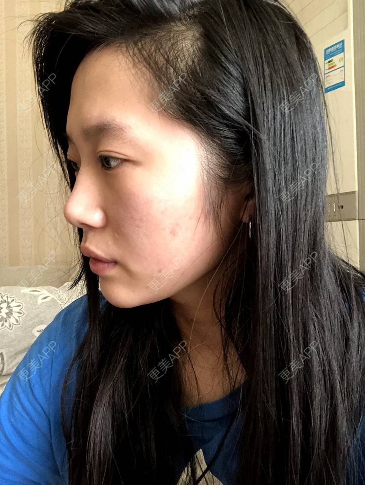 更美 - 小小的人儿@的隆鼻经验 | 隆鼻 | 苏州