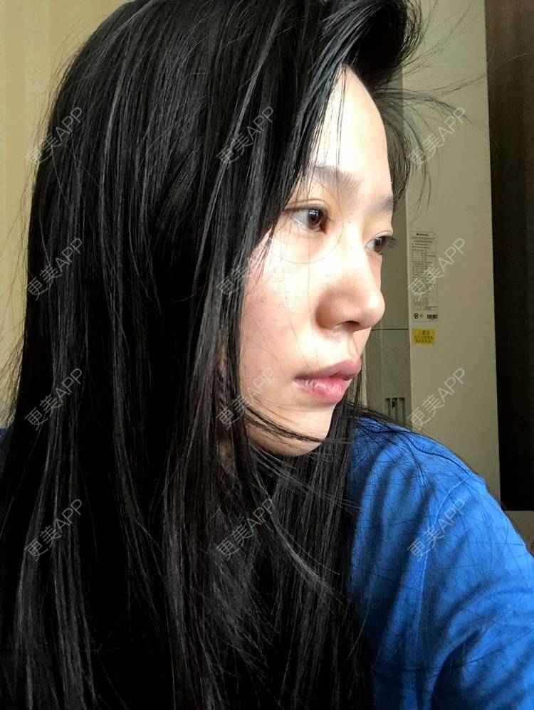 更美 - 小小的人儿@的隆鼻经验 | 隆鼻 | 苏州