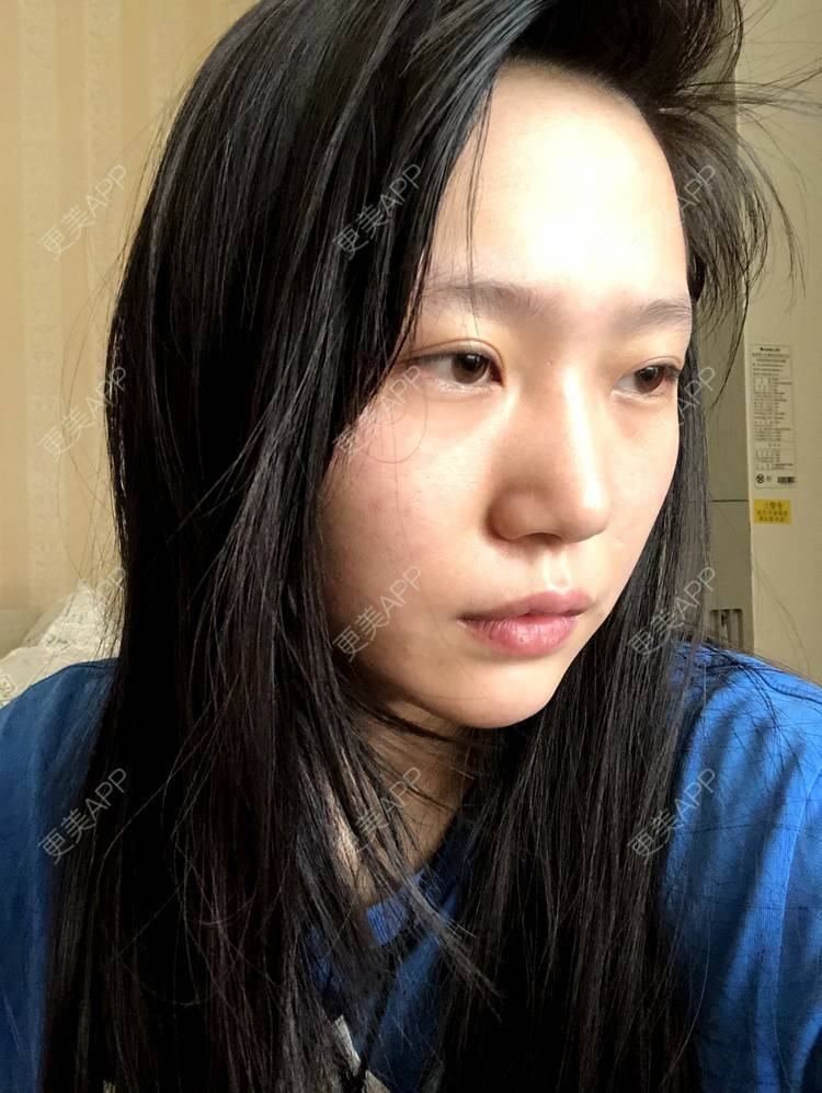 更美 - 小小的人儿@的隆鼻经验 | 隆鼻 | 苏州