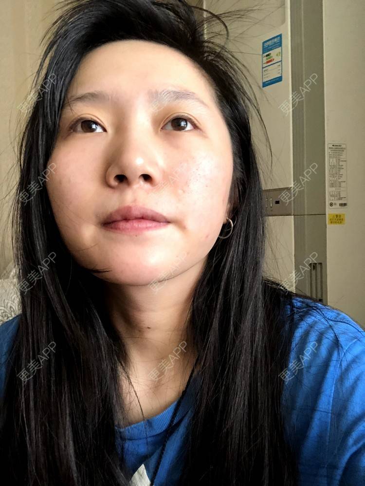 更美 - 小小的人儿@的隆鼻经验 | 隆鼻 | 苏州