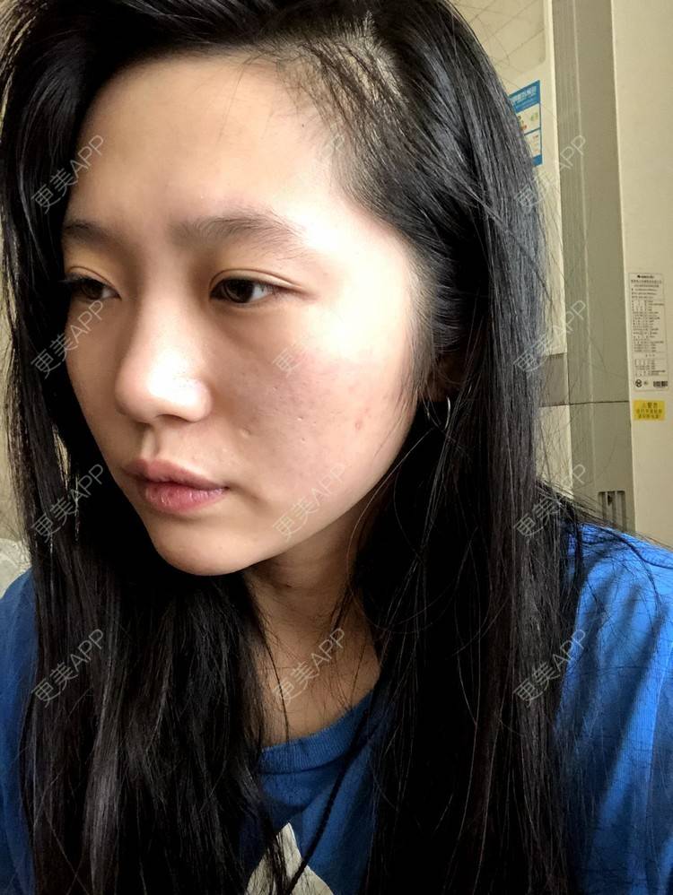 更美 - 小小的人儿@的隆鼻经验 | 隆鼻 | 苏州