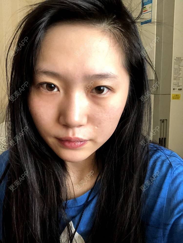 更美 - 小小的人儿@的隆鼻经验 | 隆鼻 | 苏州