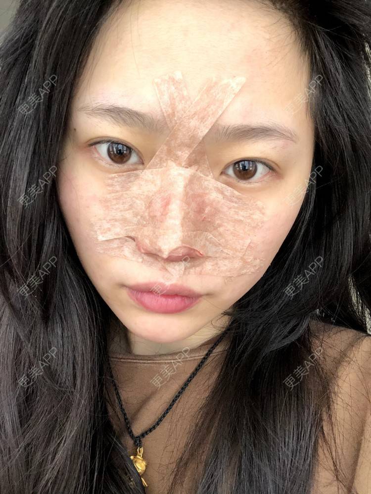 更美 - 小小的人儿@的隆鼻经验 | 隆鼻 | 苏州