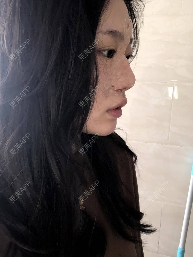 更美 - 小小的人儿@的隆鼻经验 | 隆鼻 | 苏州