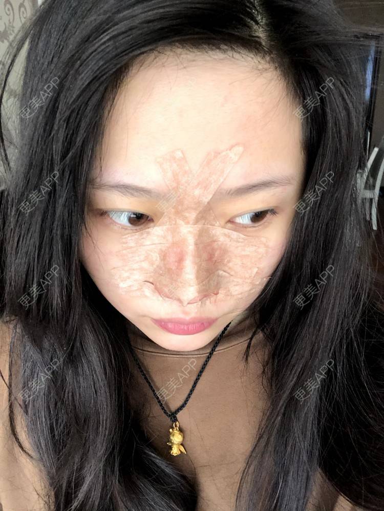 更美 - 小小的人儿@的隆鼻经验 | 隆鼻 | 苏州