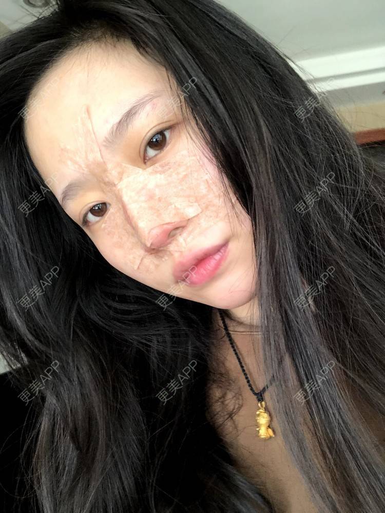 更美 - 小小的人儿@的隆鼻经验 | 隆鼻 | 苏州