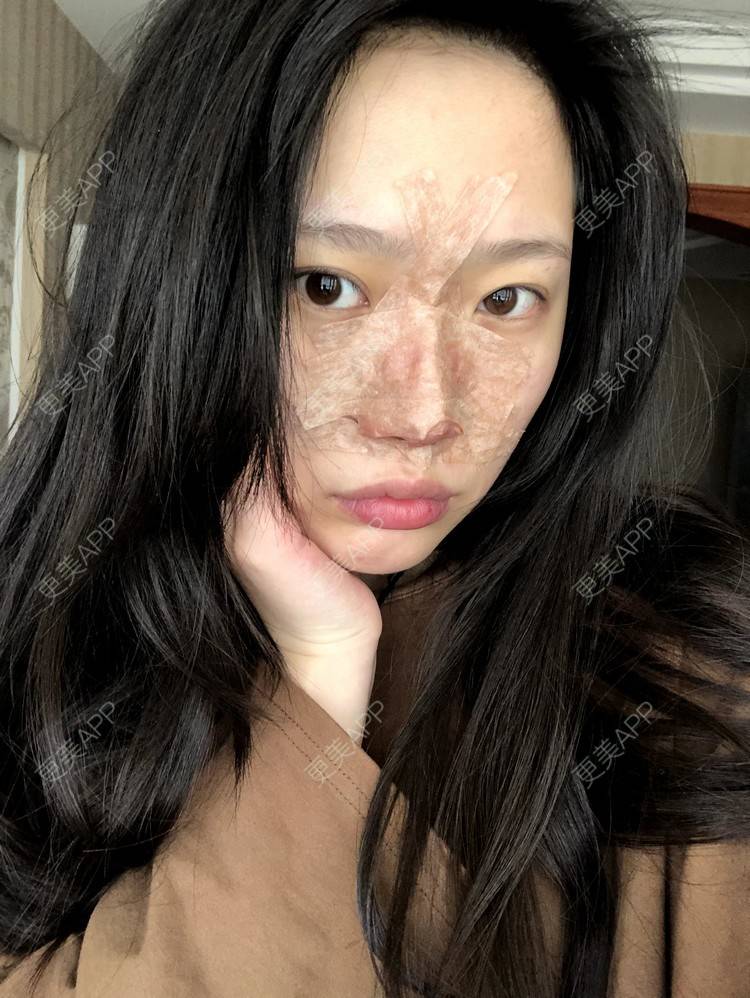 更美 - 小小的人儿@的隆鼻经验 | 隆鼻 | 苏州