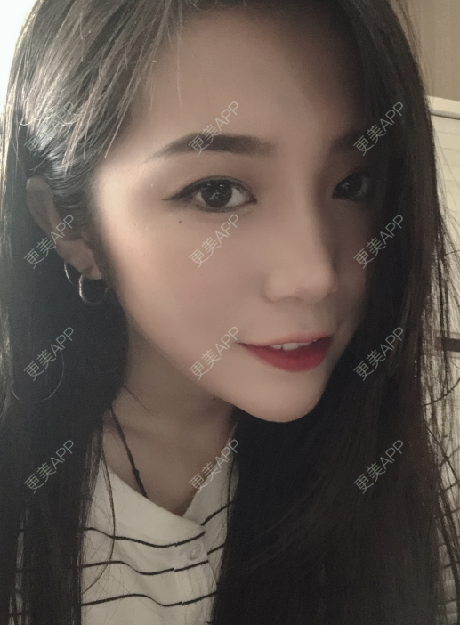 更美 - 小小的人儿@的隆鼻经验 | 隆鼻 | 苏州