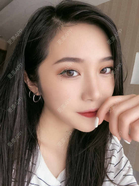 更美 - 小小的人儿@的隆鼻经验 | 隆鼻 | 苏州