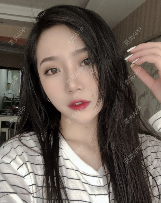 更美 - 小小的人儿@的隆鼻经验 | 隆鼻 | 苏州