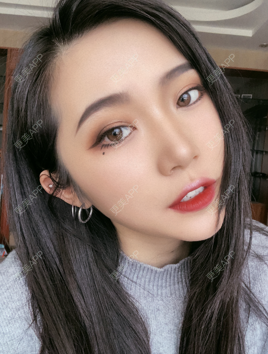 更美 - 小小的人儿@的隆鼻经验 | 隆鼻 | 苏州