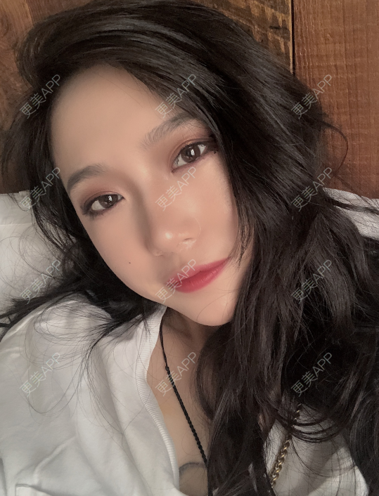 更美 - 小小的人儿@的隆鼻经验 | 隆鼻 | 苏州