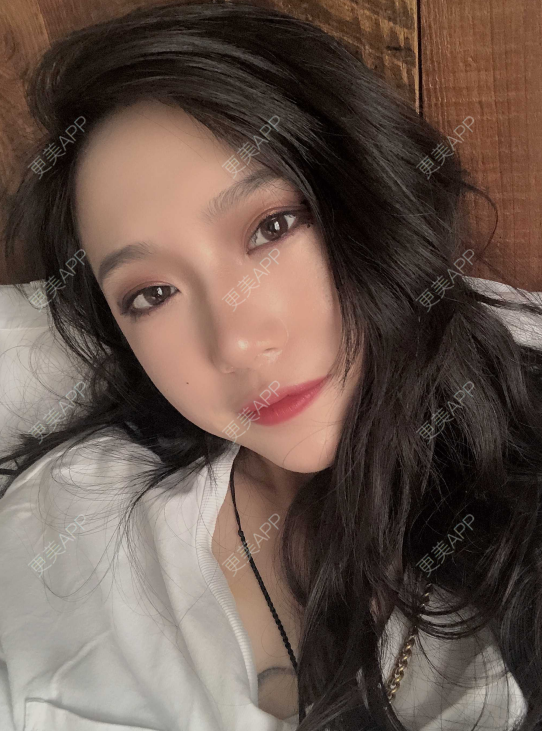 更美 - 小小的人儿@的隆鼻经验 | 隆鼻 | 苏州