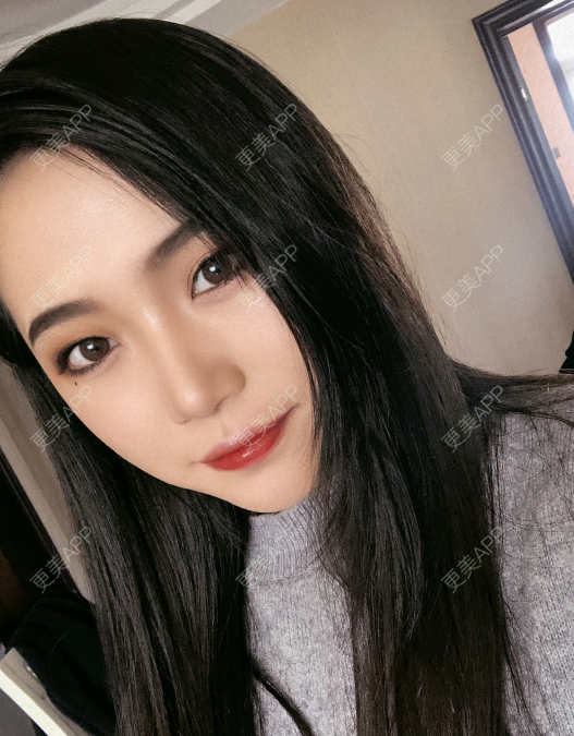 更美 - 小小的人儿@的隆鼻经验 | 隆鼻 | 苏州