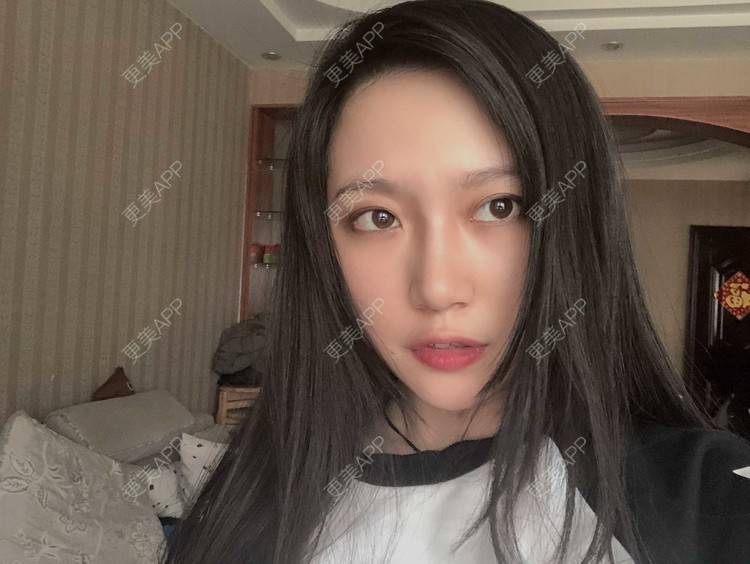 更美 - 小小的人儿@的隆鼻经验 | 隆鼻 | 苏州