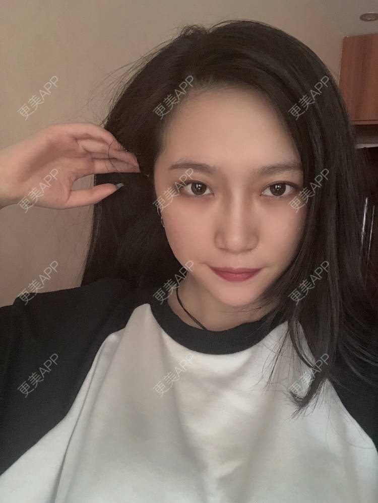 更美 - 小小的人儿@的隆鼻经验 | 隆鼻 | 苏州