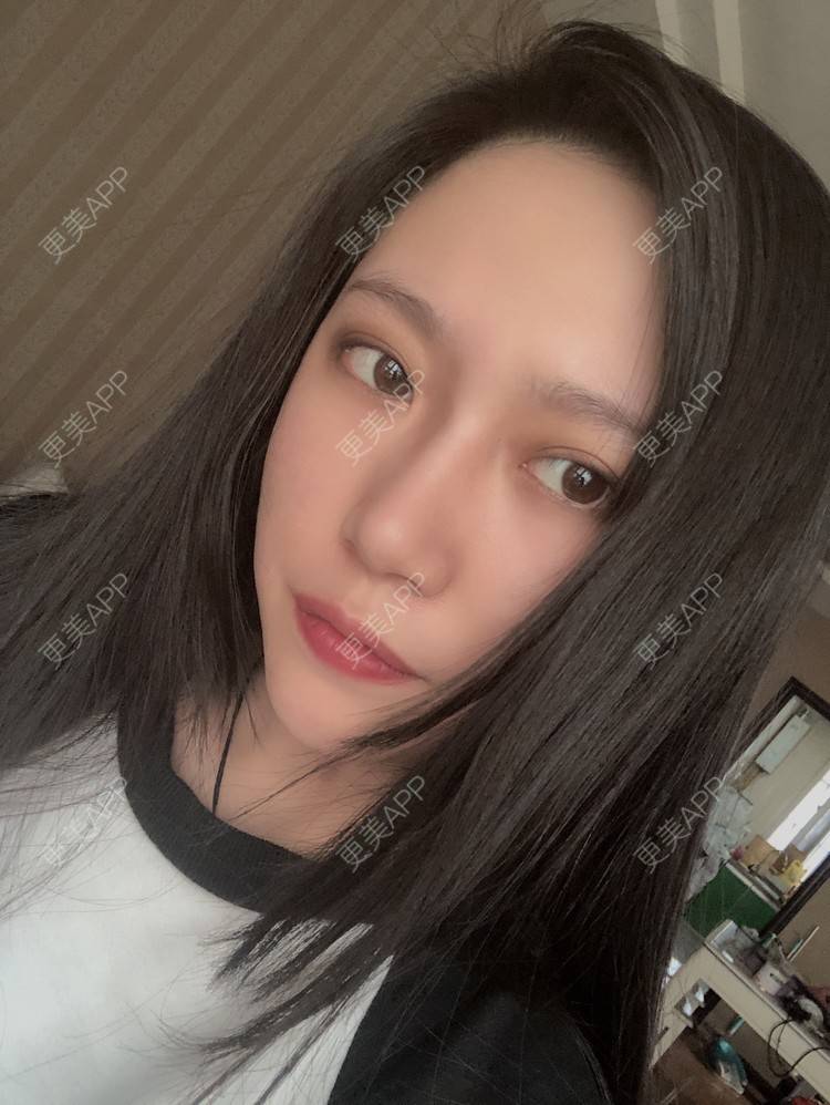 更美 - 小小的人儿@的隆鼻经验 | 隆鼻 | 苏州