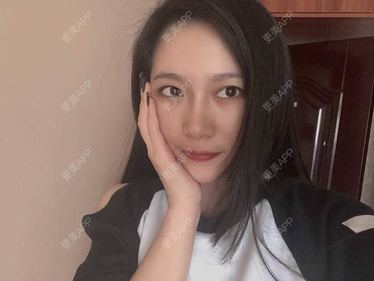 更美 - 小小的人儿@的隆鼻经验 | 隆鼻 | 苏州