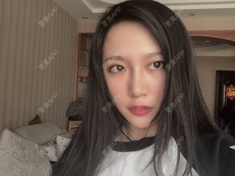 更美 - 小小的人儿@的隆鼻经验 | 隆鼻 | 苏州