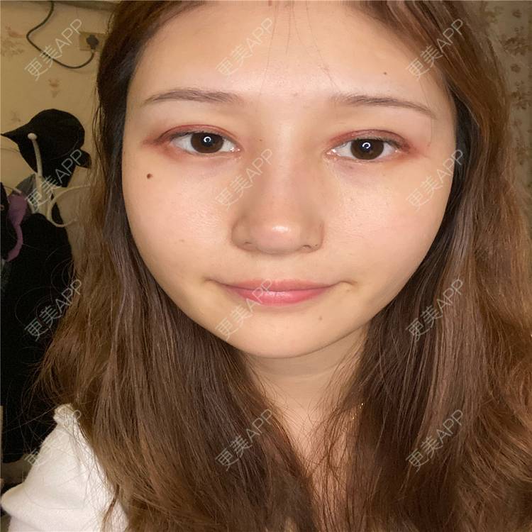 更美 - 真心已售完谝的定点双眼皮经验 | 北京 | 定点双眼皮