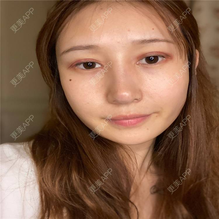 更美 - 真心已售完谝的定点双眼皮经验 | 北京 | 定点双眼皮