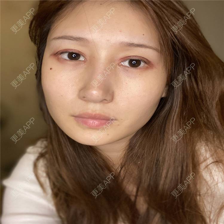 更美 - 真心已售完谝的定点双眼皮经验 | 北京 | 定点双眼皮