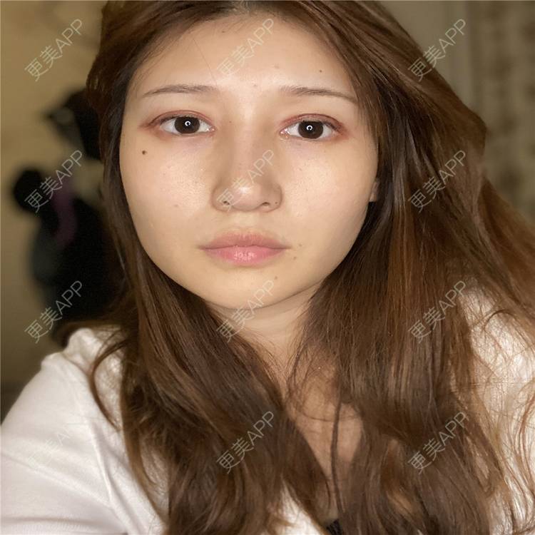 更美 - 真心已售完谝的定点双眼皮经验 | 北京 | 定点双眼皮