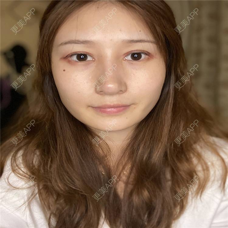 更美 - 真心已售完谝的定点双眼皮经验 | 北京 | 定点双眼皮