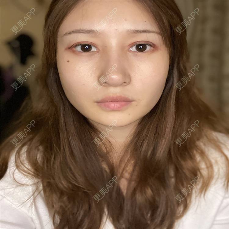 更美 - 真心已售完谝的定点双眼皮经验 | 北京 | 定点双眼皮