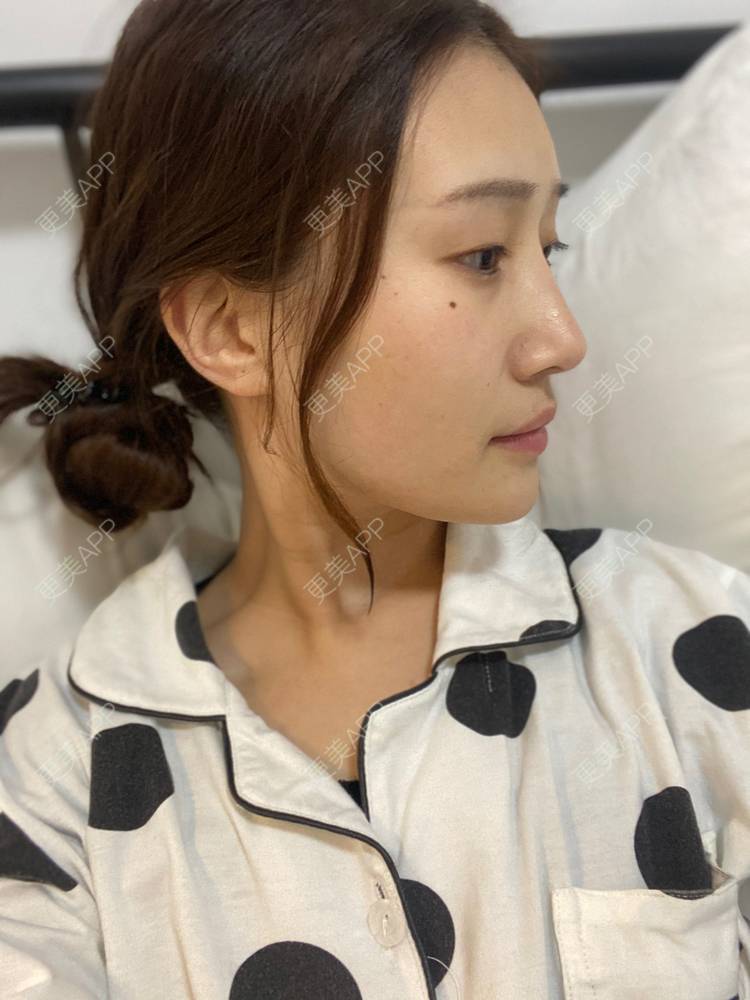 更美 - 真心已售完谝的定点双眼皮经验 | 北京 | 定点双眼皮