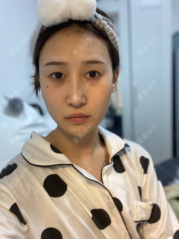 更美 - 真心已售完谝的定点双眼皮经验 | 北京 | 定点双眼皮