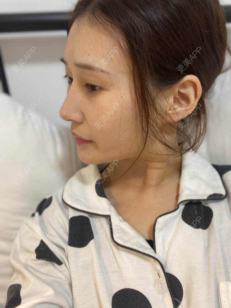 更美 - 真心已售完谝的定点双眼皮经验 | 北京 | 定点双眼皮