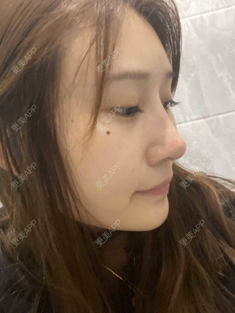 更美 - 真心已售完谝的定点双眼皮经验 | 北京 | 定点双眼皮