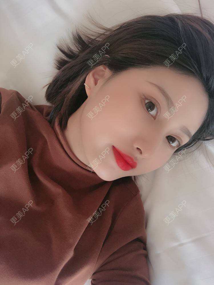 更美 - 更美用户JpxuFzIkAJ的鼻部多项经验 | 广州 | 视频日记 | 鼻部多项