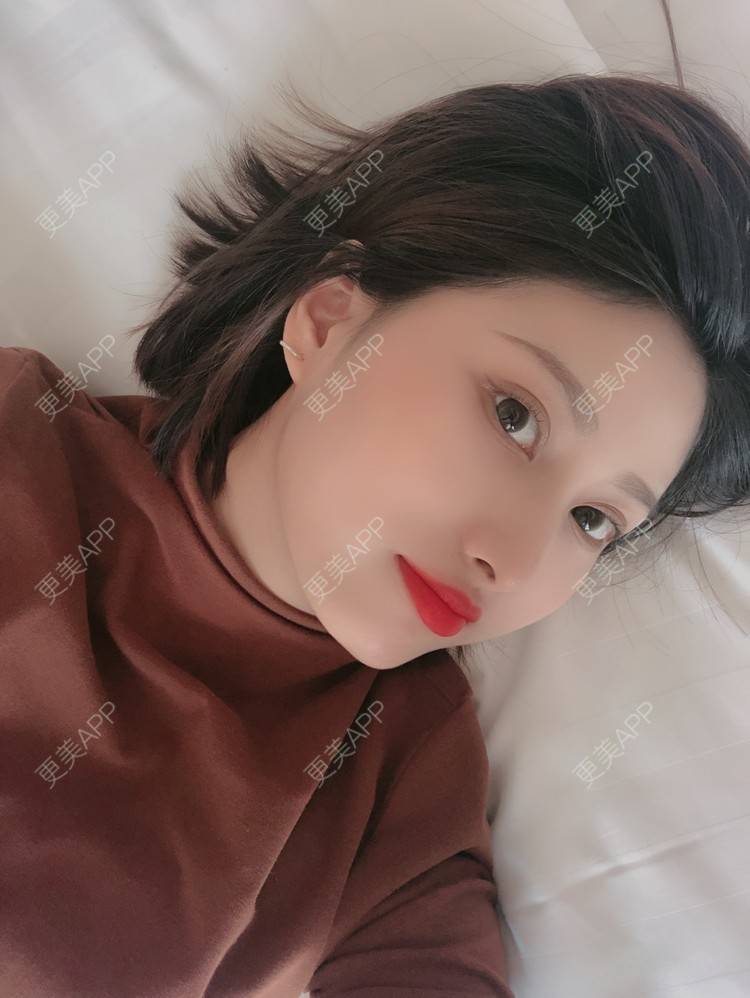 更美 - 更美用户JpxuFzIkAJ的鼻部多项经验 | 广州 | 视频日记 | 鼻部多项