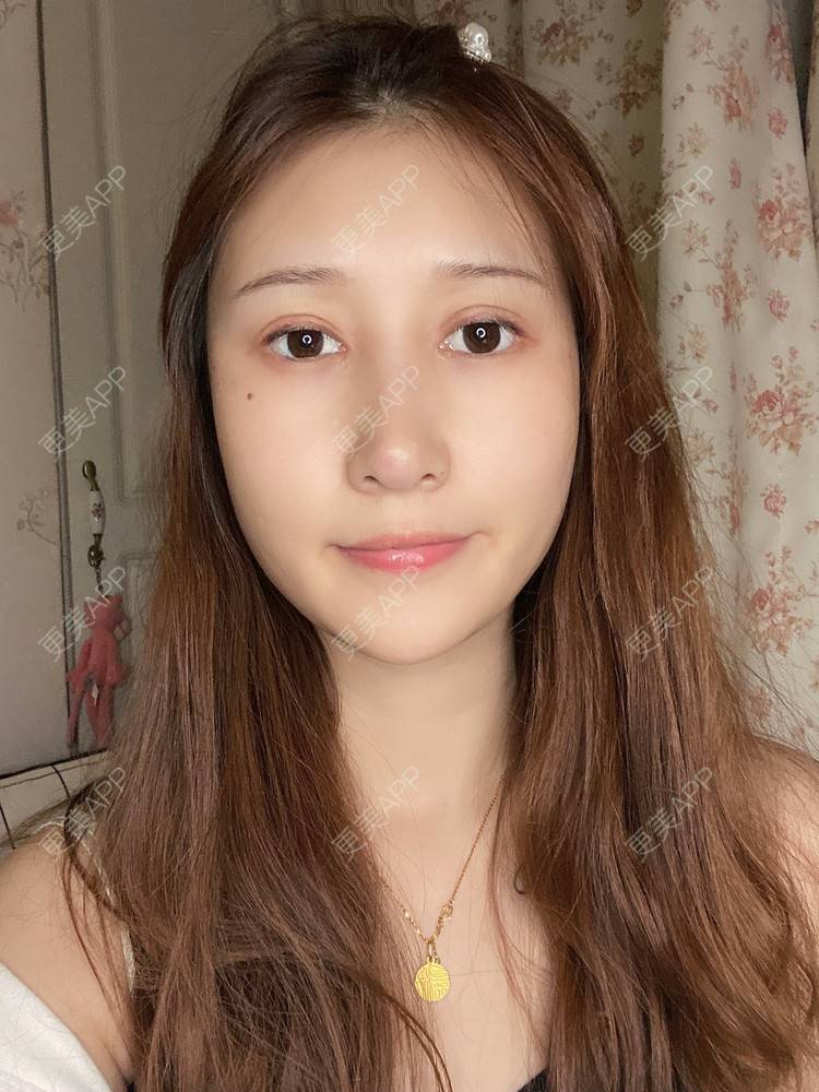 更美 - 真心已售完谝的定点双眼皮经验 | 北京 | 定点双眼皮