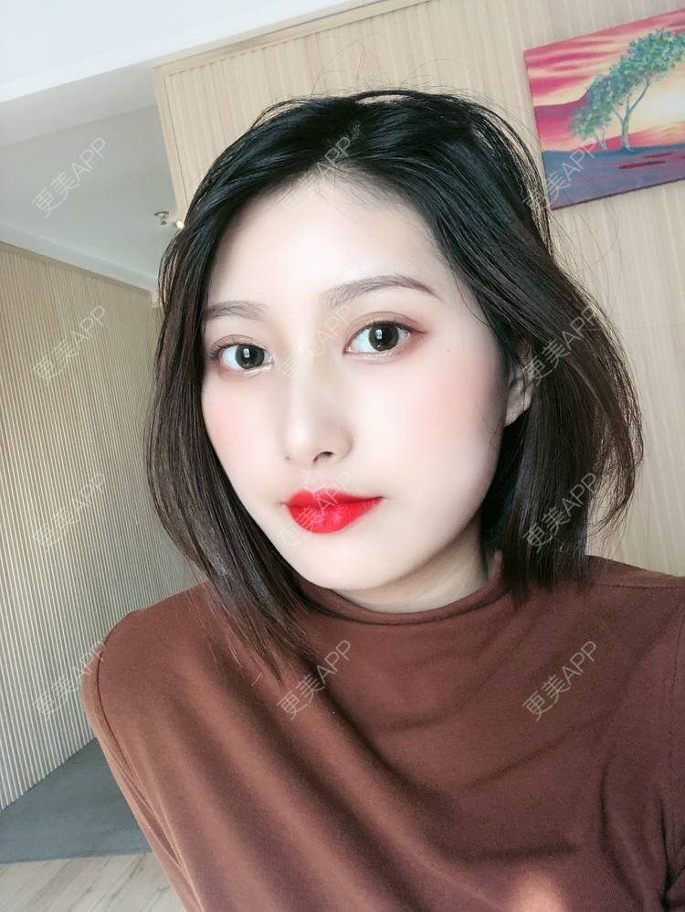 更美 - 更美用户JpxuFzIkAJ的鼻部多项经验 | 广州 | 视频日记 | 鼻部多项
