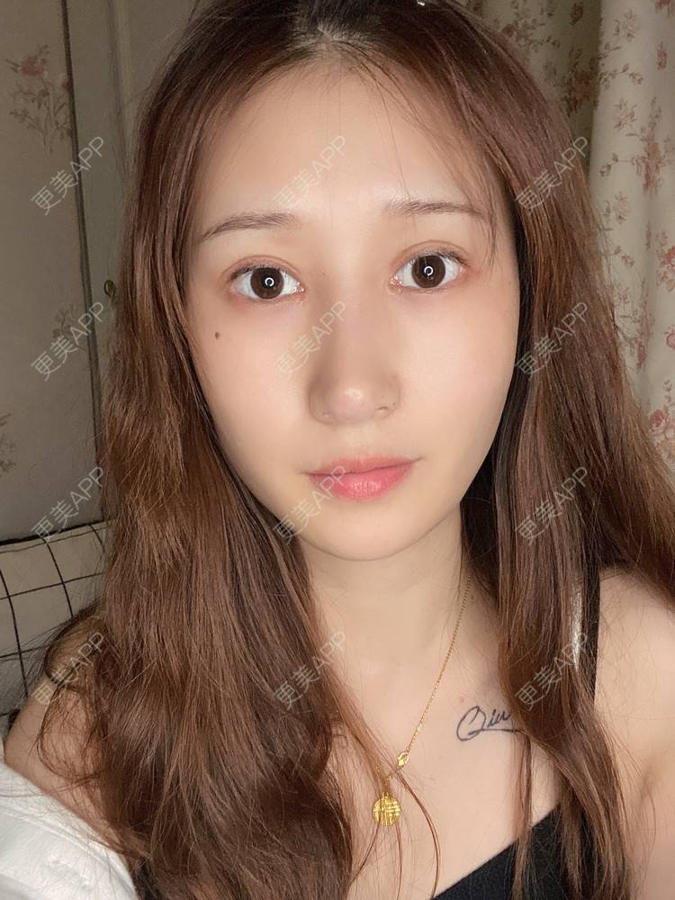 更美 - 真心已售完谝的定点双眼皮经验 | 北京 | 定点双眼皮