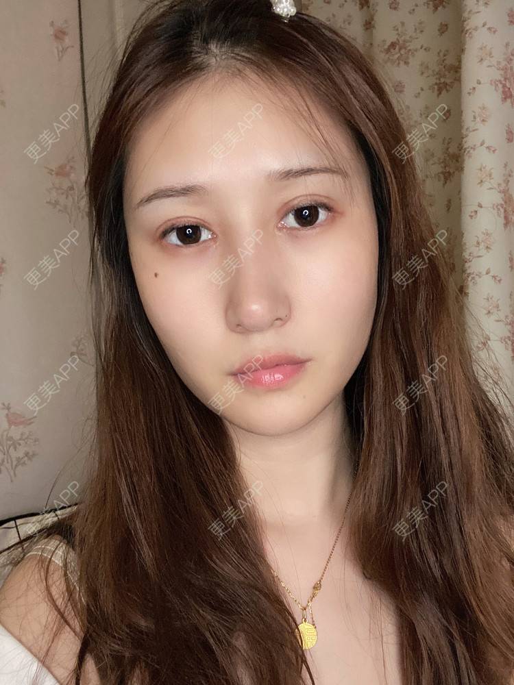 更美 - 真心已售完谝的定点双眼皮经验 | 北京 | 定点双眼皮